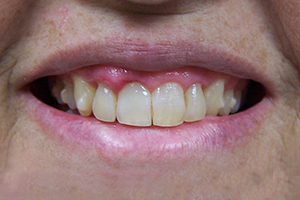 Gingival Contouring After