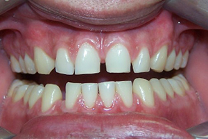 Dental Restorations Before