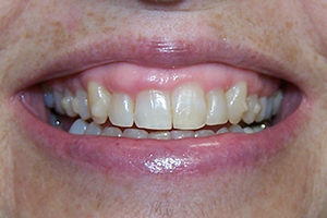 Gingival Contouring Before