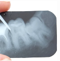 X Ray of teeth
